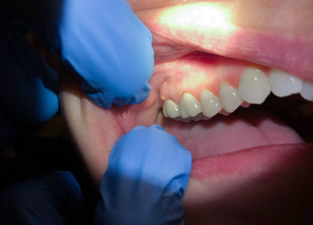 Best Emergency Root Canal Treatment in Maan, ND